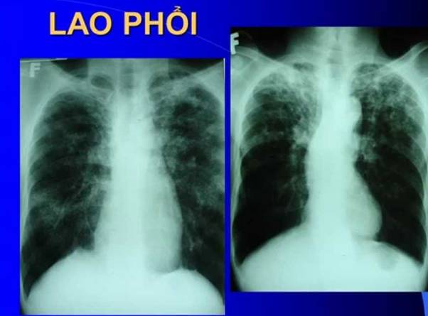 Những điều cần biết về bệnh lao phổi